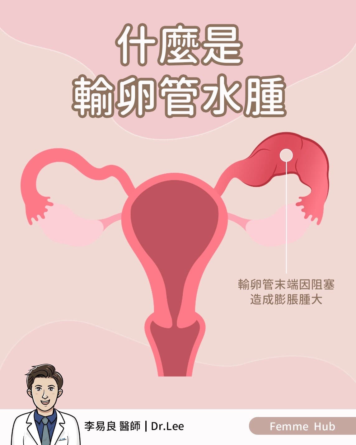 👨🏻‍⚕什麼是輸卵管水腫（Hydrosalpinx）？ 『 上篇 』.jpg