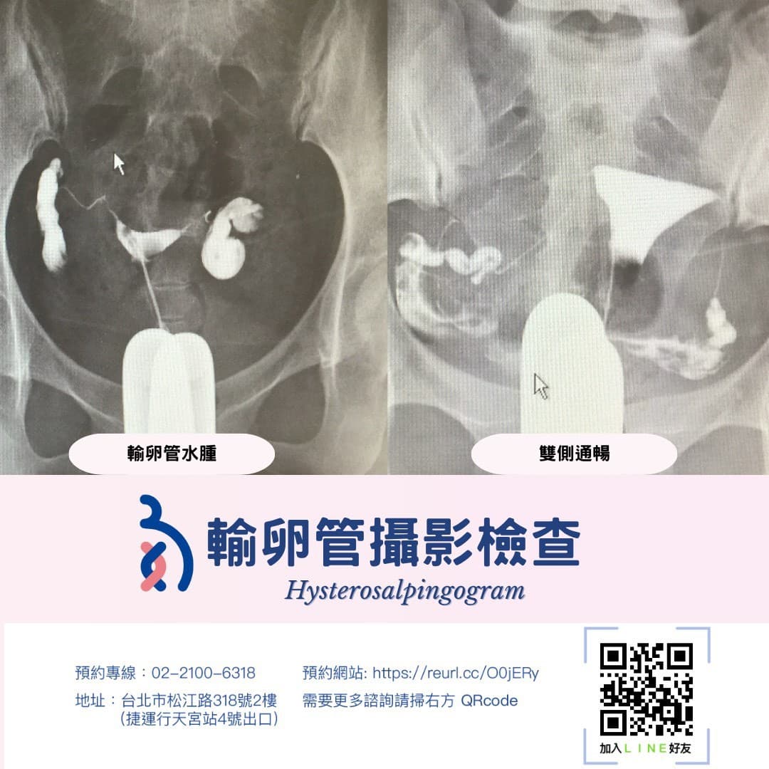 輸卵管攝影檢查 🧐是什麼？.jpg