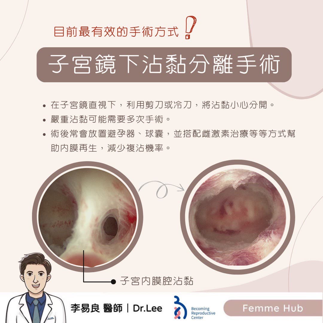 子宮內膜腔沾黏(下篇).jpg