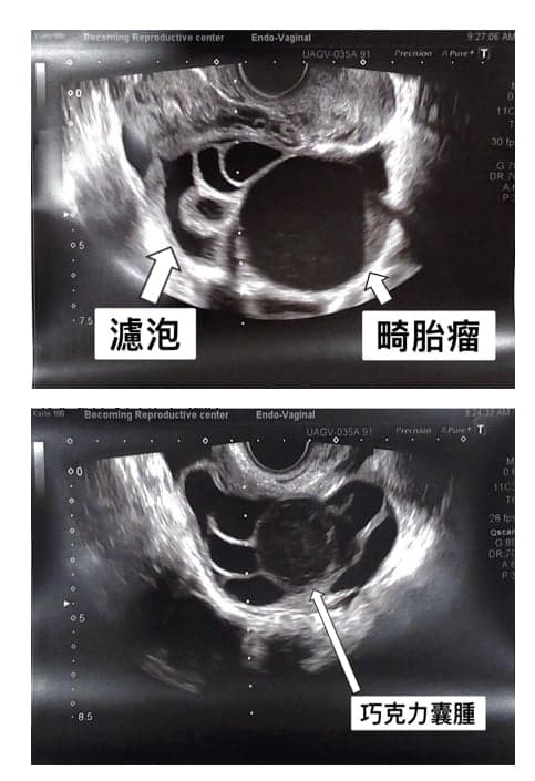 卵巢良性腫瘤🆚取卵.jpg