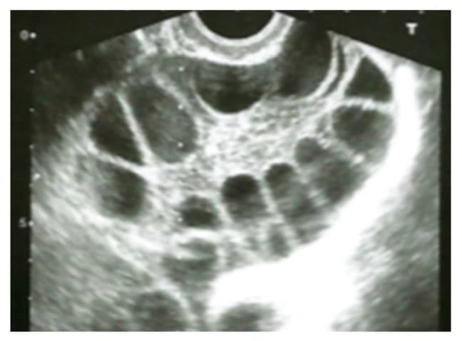👩🏫【淺談多囊性卵巢症候群(PCOS)】1.jpg