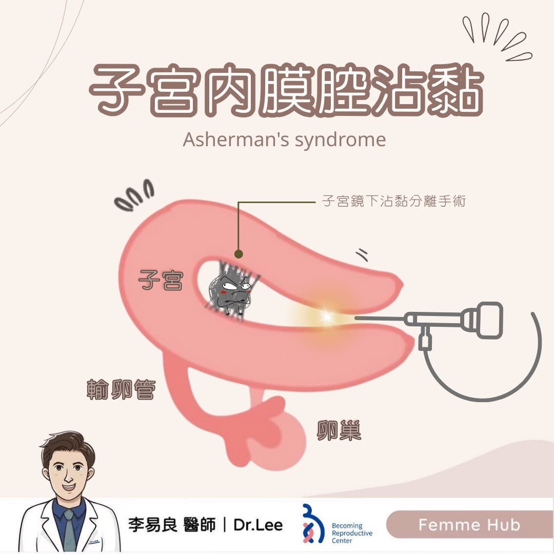 什麼是「子宮內膜腔沾黏」?.jpg
